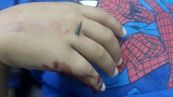 شاهد مسامير مجنّحة اخترقت جسد طفل سوري بقصف للأسد