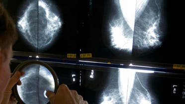  In this Thursday, May 6, 2010 file photo, a radiologist uses a magnifying glass to check mammograms for breast cancer in Los Angeles. A Canadian study published Wednesday, Feb. 12, 2014. (AP)