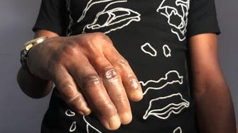 Nigerian artist makes dark skin prosthetics to boost patients’ confidence