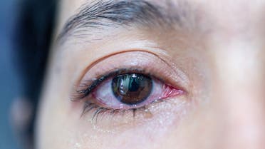A person with red eyes looks at the camera. (Shutterstock)
