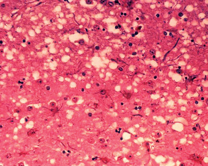 أنسجة دماغ بقرة مصابة بمرض جنون البقر تظهر ثقوب مجهرية نموذجية في المادة الرمادية