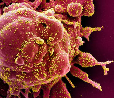 Colorized scanning electron micrograph of an apoptotic cell infected with SARS-COV-2 virus particles, also known as novel coronavirus, isolated from a patient sample. (Reuters)
