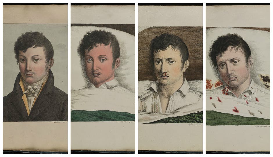 رسم تخيلي يبرز تطور أعراض الحمى الصفراء على شخص بمدينة فيلادلفيا عام 1793