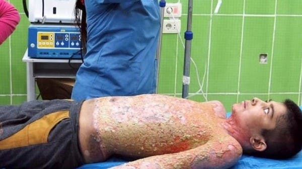 أتذكرون طفل الفوسفور المحترق؟.. مأساة مستمرة