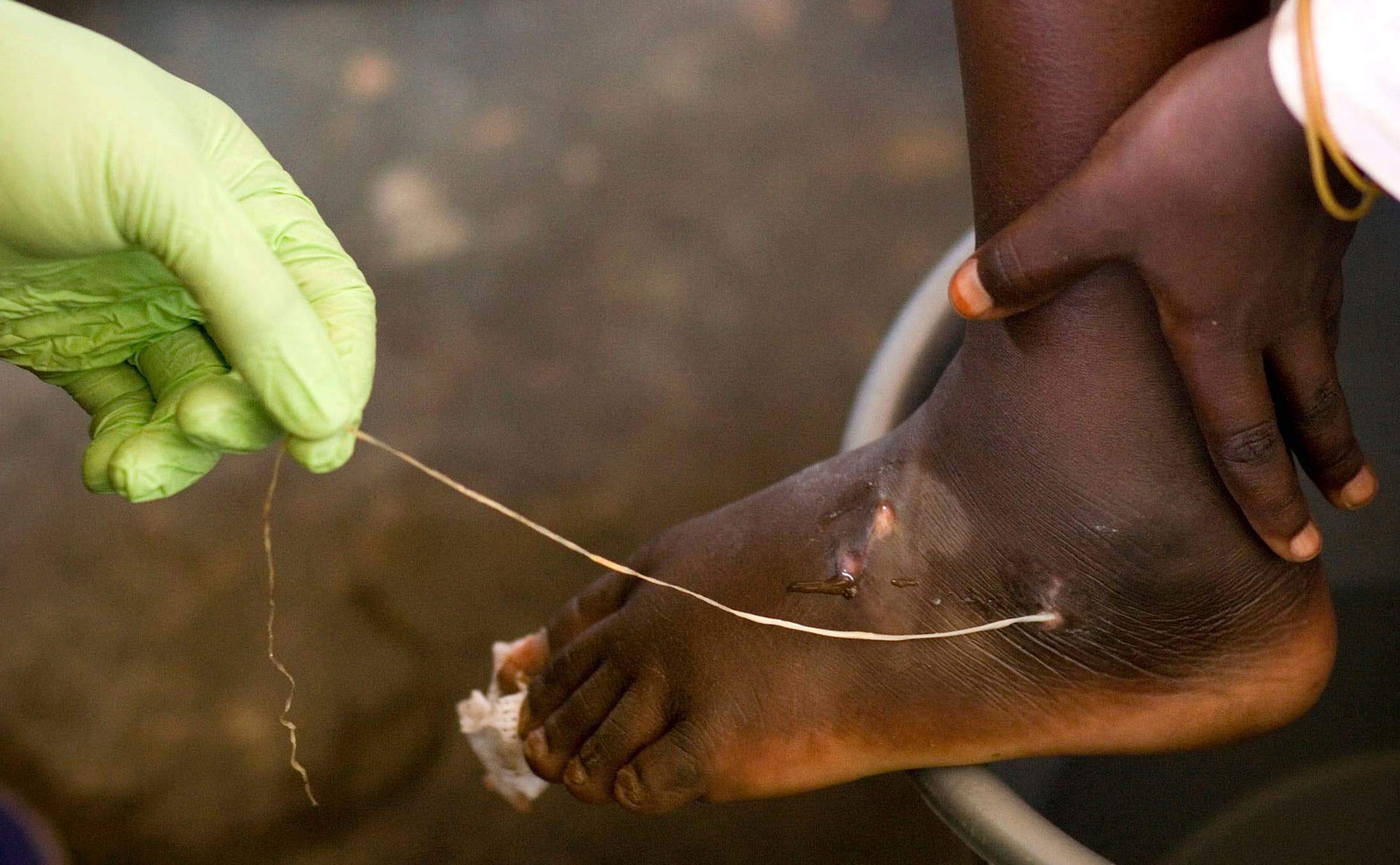 A Guinea worm extracted from a child’s foot in Ghana in 2007. (File photo: AP)
