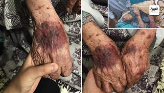 صور لإصابات مروعة لأم جبر وشاح تشعل غضب الشارع الفلسطيني