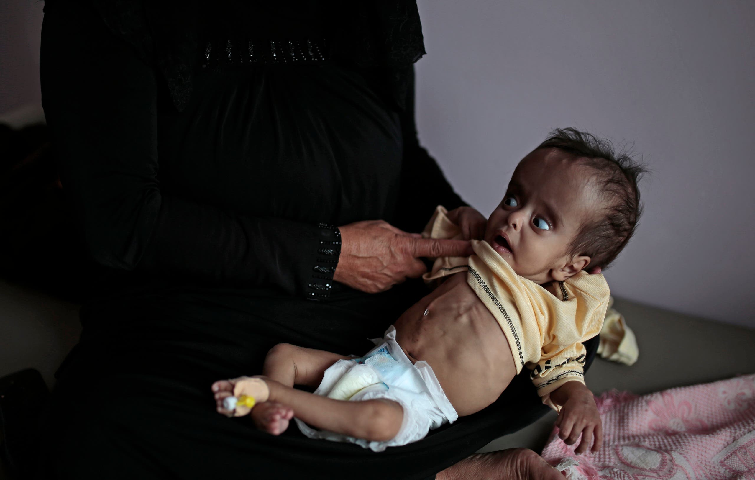 طفل في صنعاء يعاني من سوؤ التغذية 