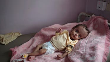 A malnourished boy lies in a bed waiting to receive treatment at a feeding center at Al-Sabeen hospital in Sanaa, Yemen, Saturday, June 27, 2020. (AP Photo/Hani Mohammed)