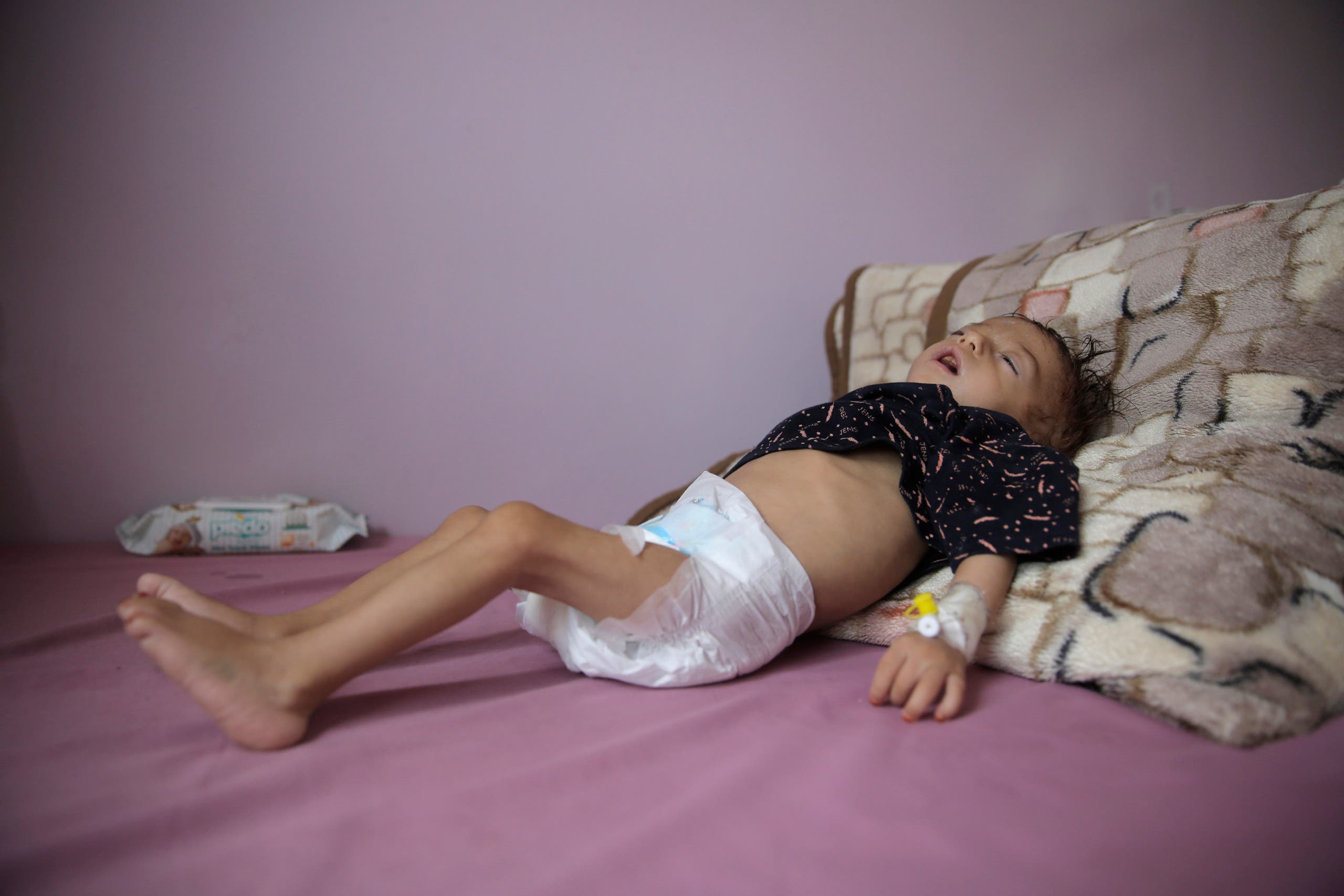طفل في صنعاء يعاني من سوؤ التغذية 