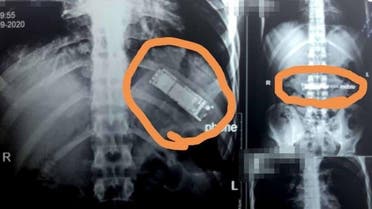Egypt: Rear Operation took place where a mobile phone took out from patient stomach