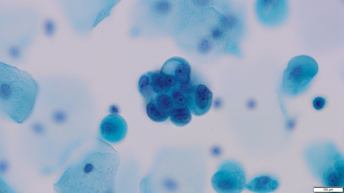 Image shows cancer cells in urine. (Courtesy: University of Manchester)