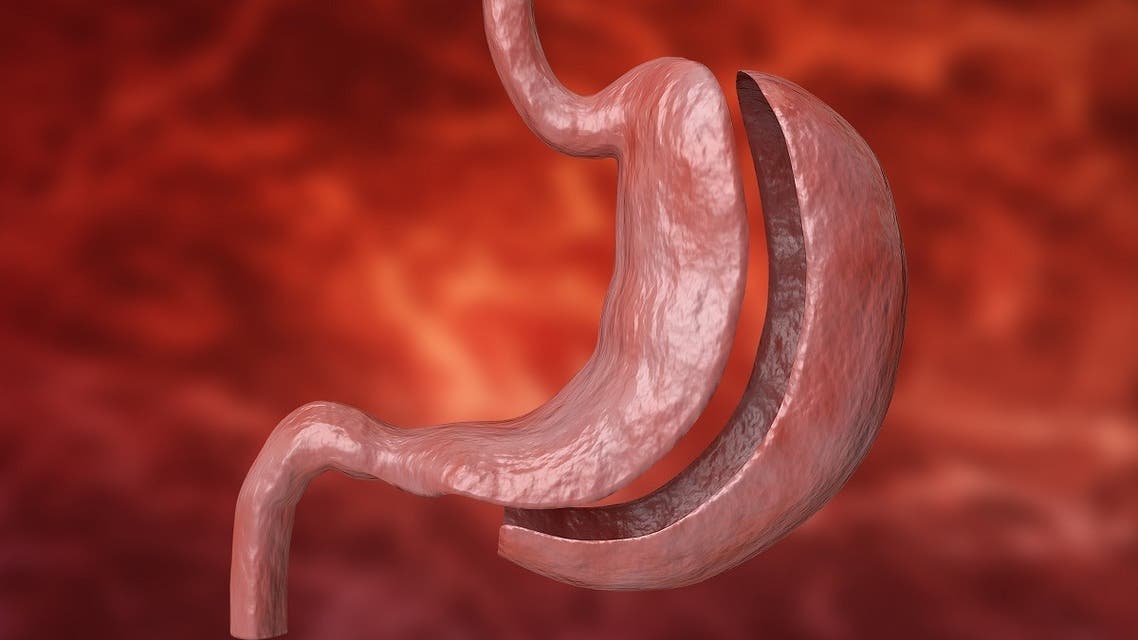 Bariatric surgery with reduction of the size of the stomach for weight loss and loss of body weight. (Gilnature via iStock)