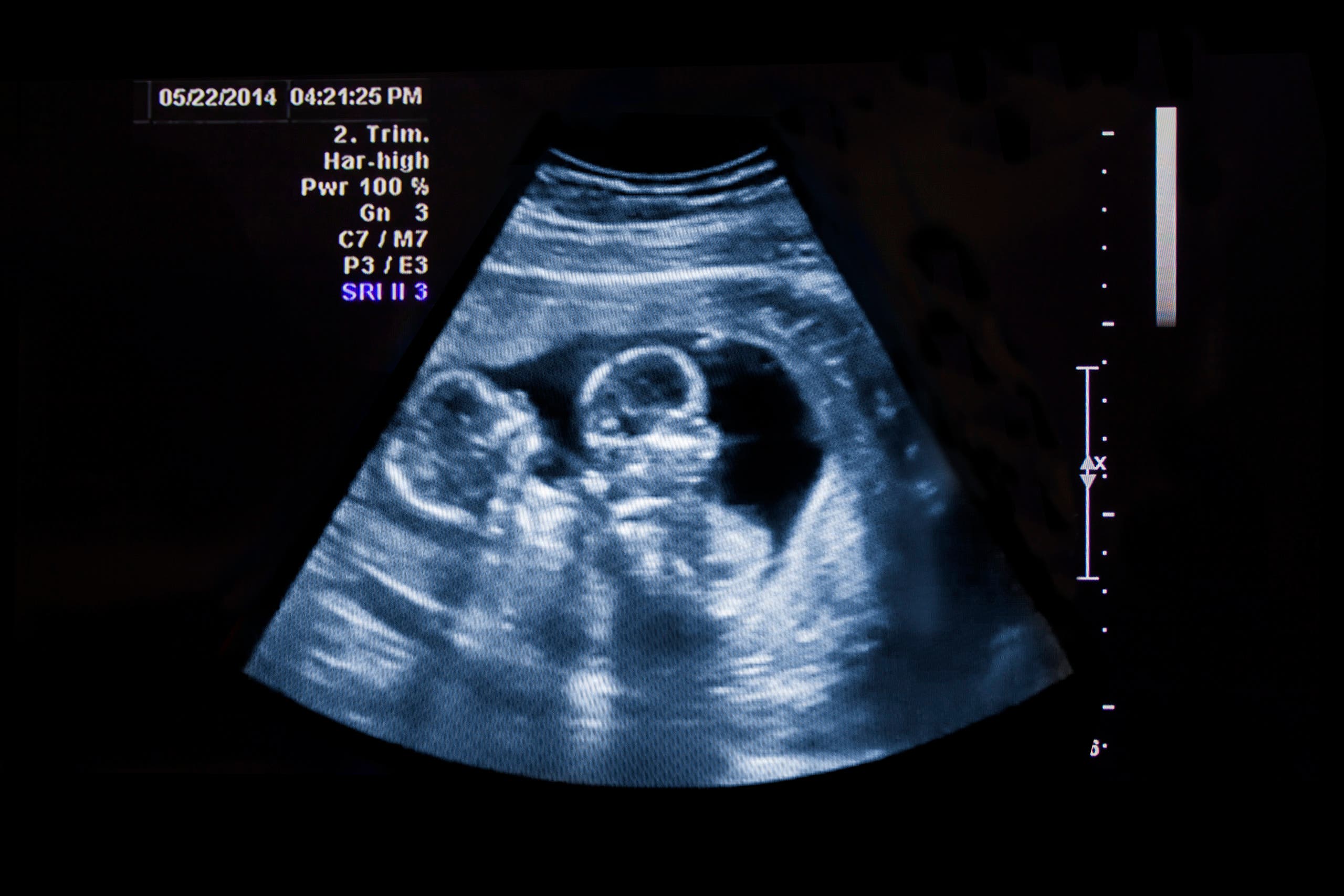 Twin babies are seen in an ultrasound. (iStock)