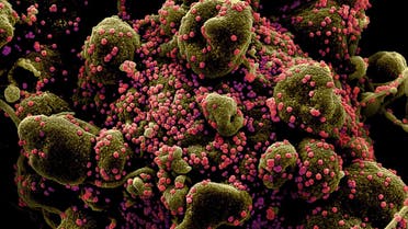 Colorized scanning electron micrograph of an apoptotic cell (greenish brown) heavily infected with SARS-COV-2 virus particles (pink), also known as novel coronavirus, isolated from a patient sample. (Reuters)