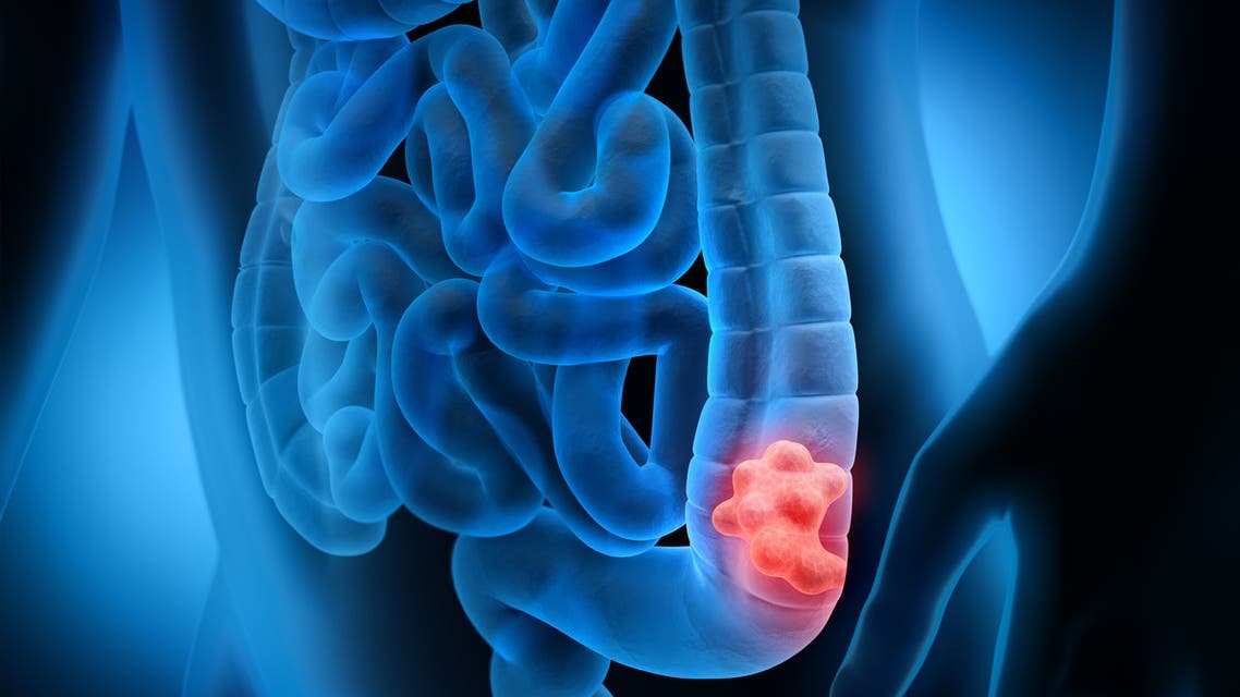 3d illustration of colon cancer - tumor stock photo