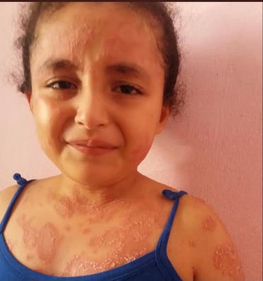 الطفلة تعاني من مرض جلدي خطير