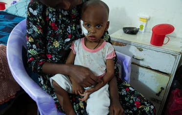 طفلة تعاني من سوء التغذية الحاد في تيغراي