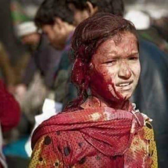 طفلة جريحة في إنفجار مطار كابل