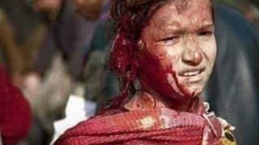 طفلة جريحة في إنفجار مطار كابول