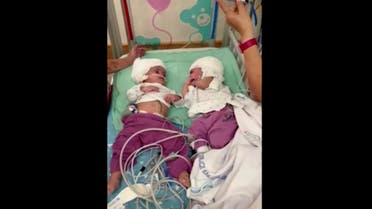 One-year-old twin Israeli girls who were born conjoined at the head, back to back, can make eye contact for the first time after undergoing rare separation surgery. (Screengrab)
