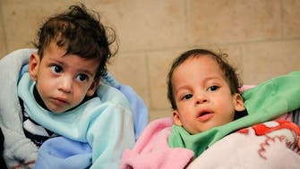 Yemeni separated conjoined twins return home from Jordan: UNICEF