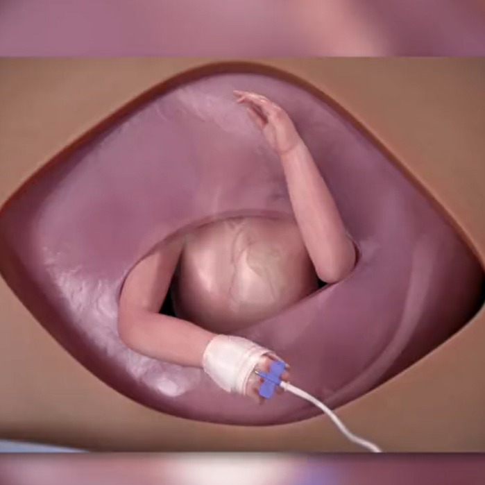 فيديو مدهش.. جراحة لجنين داخل بطن أمه على يد طبيب سعودي