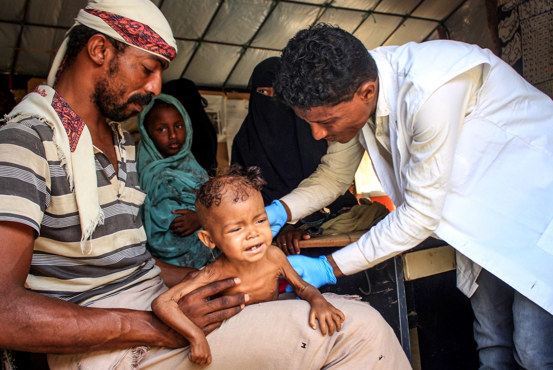 طفل يعاني من سوء تغذية حاد في حجة في اليمن