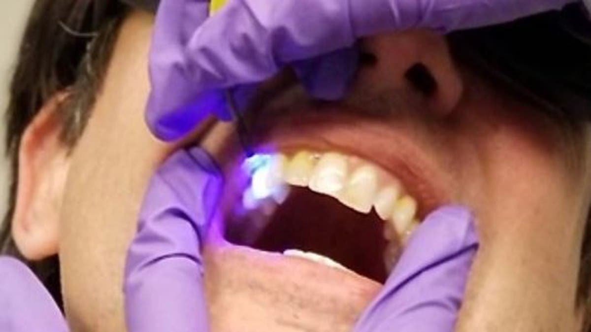 جهاز مبتكر للكشف المبكر عن خطر تسوس الأسنان