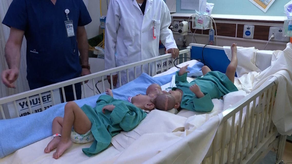 Saudi doctors separate conjoined twins from war-torn Yemen