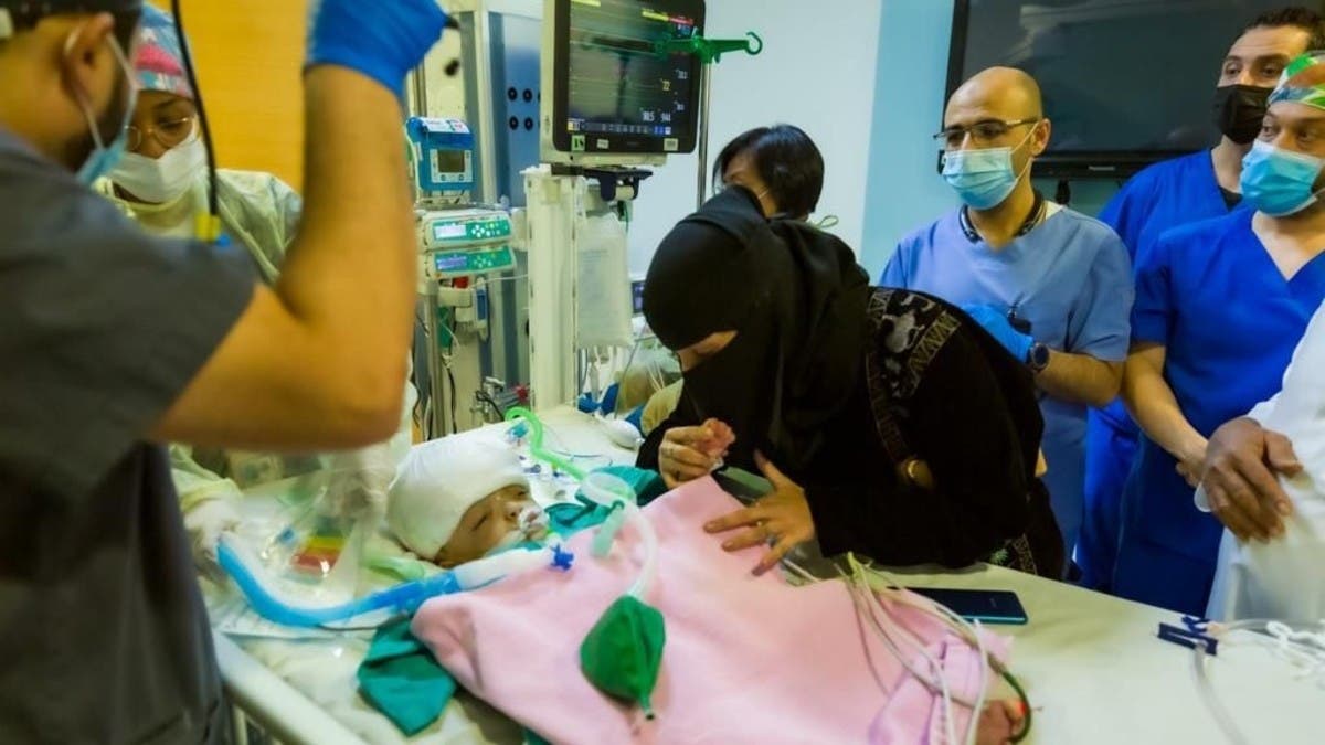 نجاح فصل التوأم السيامي اليمني “يوسف وياسين” في عملية استغرقت 15 ساعة