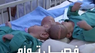فريق طبي سعودي ينجح بفصل توأم ملتصق من الرأس 