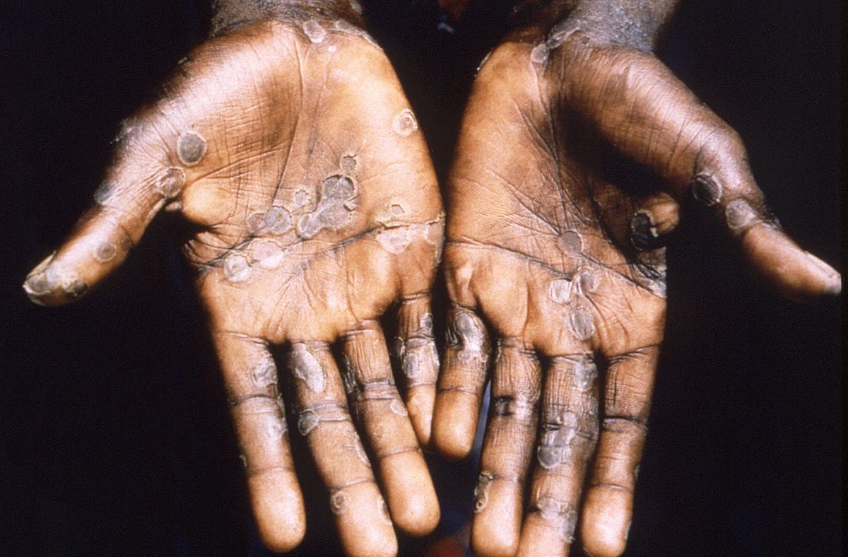 The palms of a monkeypox case patient from Lodja, a city located within the Katako-Kombe Health Zone, are seen during a health investigation in the Democratic Republic of Congo in 1997. (Reuters)