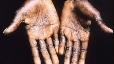 The palms of a monkeypox case patient from Lodja, a city located within the Katako-Kombe Health Zone, are seen during a health investigation in the Democratic Republic of Congo in 1997. (Reuters)