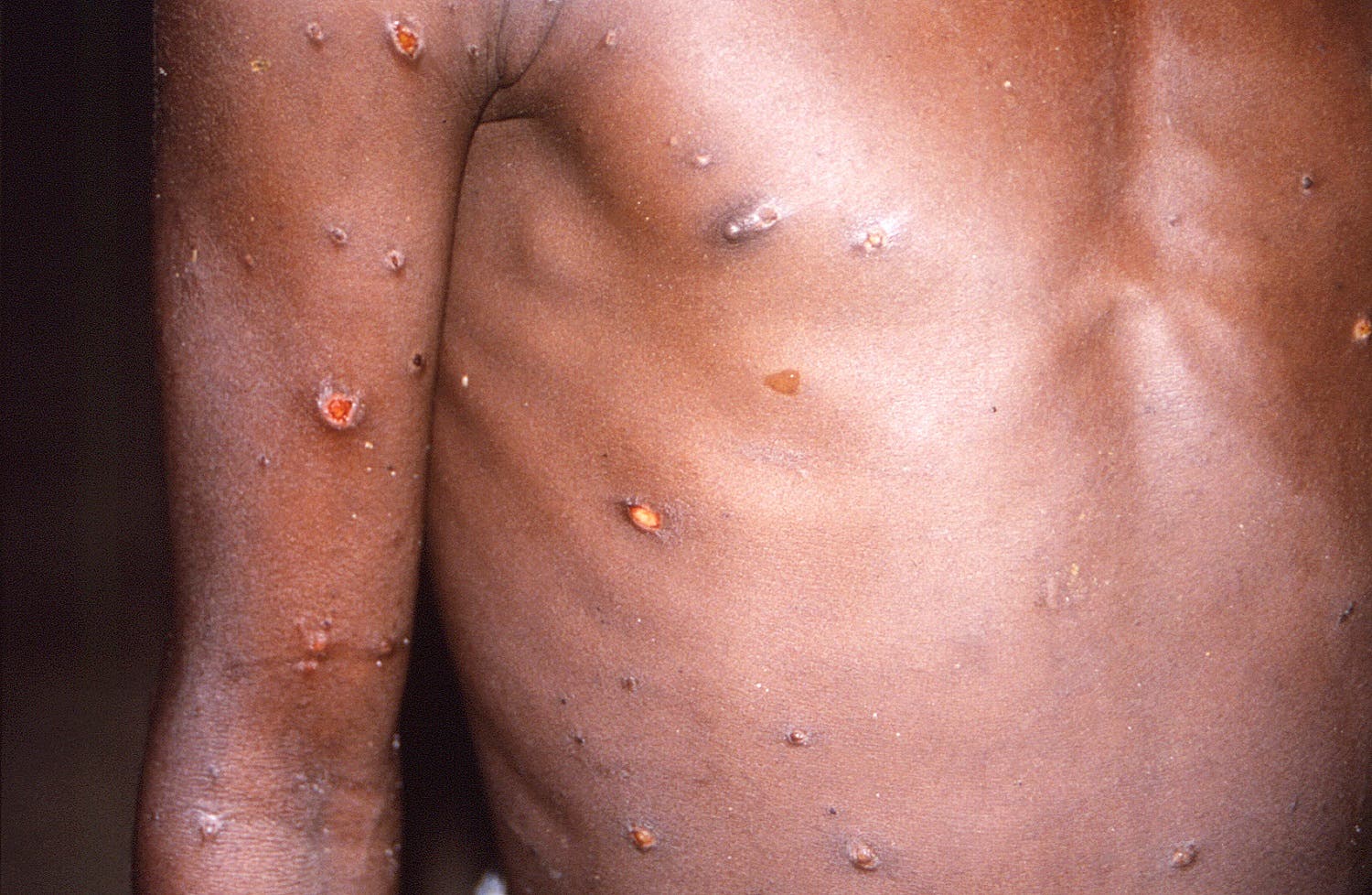 طفرات جلدية على جسم شاب مصاب بجدري القرود (أرشيفية)