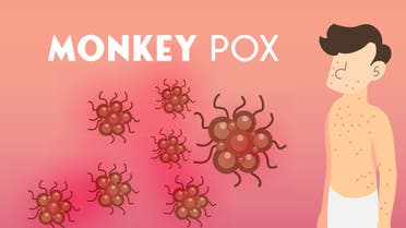 Illustration of monkeypox virus, Vector of a person with monkeypox, Concept of monkeypox, illustration of hives on the skin of monkeypox stock illustration