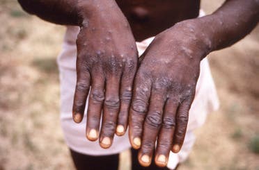 طفرات جلدية على يدي شاب مصاب بجدري القرود (أرشيفية)