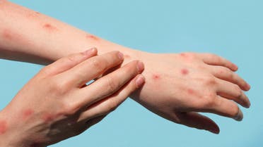 Monkeypox new disease dangerous over the world. Patient with Monkey Pox. Painful rash, red spots blisters on the hand. Close up rash, human hands with Health problem. Banner, copy space. stock photo