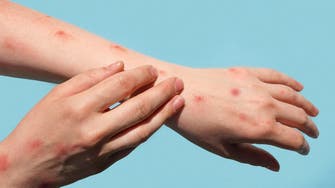 Brazil reports its first monkeypox-related death