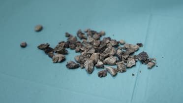 Stones removed from Mian Khan's kidney. (Supplied: Burjeel Specialty Hospital) 