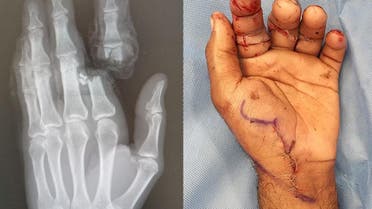 X-ray image showing the detached finger (left), and the hand after replanting the finger (right). (Supplied)