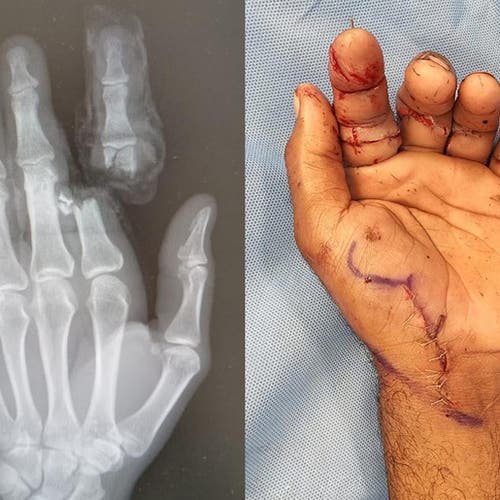 Egyptian farmer gets back amputated finger hours after Abu Dhabi accident