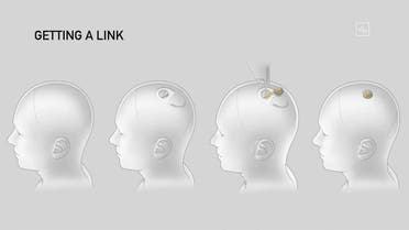 This video grab made from the online Neuralink livestream shows a drawing of the different steps of the implantation of a Neuralink device seen during a presentation on August 28, 2020. Futurist entrepreneur Elon Musk late August 28 demonstrated progress made by his Neuralink startup in meshing brains with computers, saying the work is vital to the future of humanity. / AFP / Neuralink / - / RESTRICTED TO EDITORIAL USE - MANDATORY CREDIT AFP PHOTO / NEURALINK  - NO MARKETING - NO ADVERTISING CAMPAIGNS - DISTRIBUTED AS A SERVICE TO CLIENTS