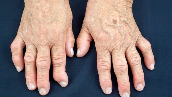 Revolutionary new technology for the treatment of arthritis