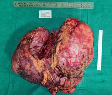 Surgeons removed the 4.5kg tumor (pictured) during a six-hour operation. (Supplied)