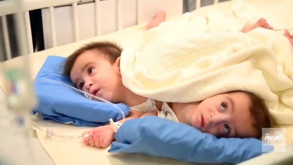 Doctors In Saudi Arabia Begin Operation To Separate Iraqi Conjoined Twins TrendRadars