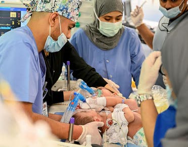 The surgery to separate the conjoined twins consists of six stages. (SPA)