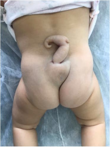 من مجلة Journal of Pediatric Surgery Case Reports 