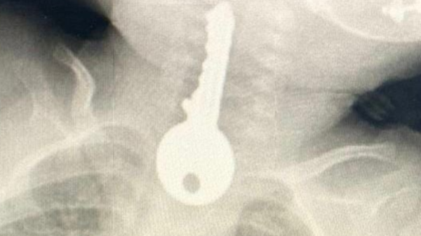 A Saudi child swallows a key..and a documented photo