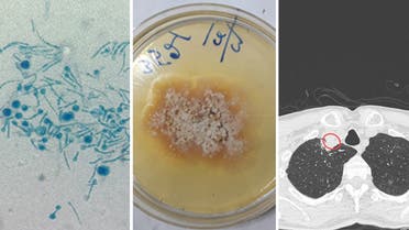 A combination image of the scans and tests published in Medical Mycology Case Reports for the case study of an Indian man with a fungus infection. (Medical Mycology Case Reports)