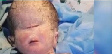 صور صادمة لولادة طفل بعين واحدة في العراق.. والطب يوضح
